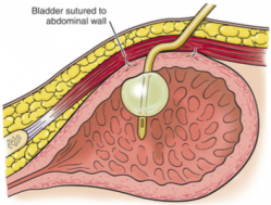 vessie furet cystostomie obstruction urétrale